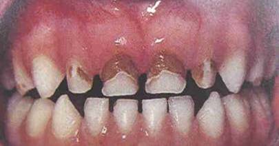 toothdecay02.jpg