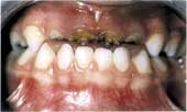toothdecay01.jpg